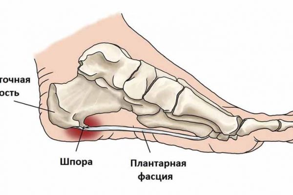 Как избавиться от пяточной шпоры?